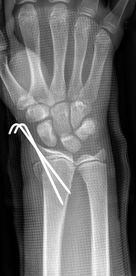 Рис.2: На рентгенограмі видно випинання спиць за межами кістки при застосуванні техніки закритої репозиції з фіксацією спицями