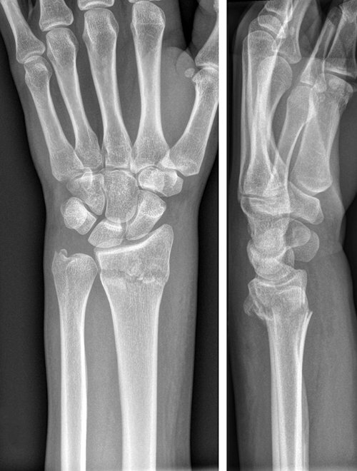 Рис.4: Рентгенограма нестабільного позасуглобового перелому дистального відділу променевої кістки зі зміщенням
