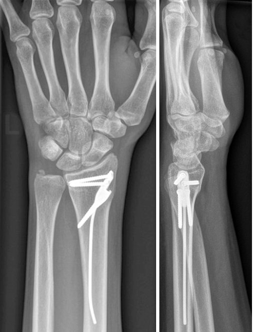 Рис.6: Рентгенограма через 3 місяці після зрощення перелому в анатомічно правильному положенні