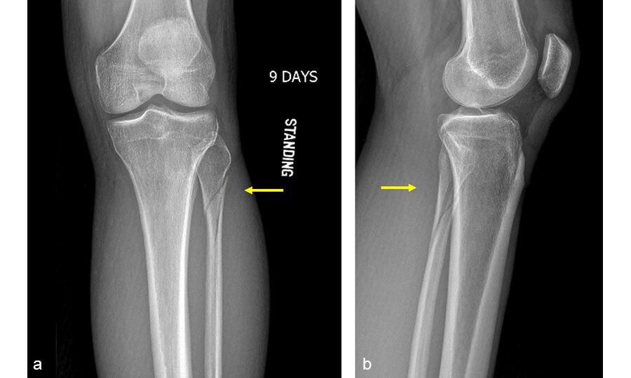 Рис.1. Рентгенограми проксимального перелому малогомілкової кістки в АР (а) та ML (b) проекціях