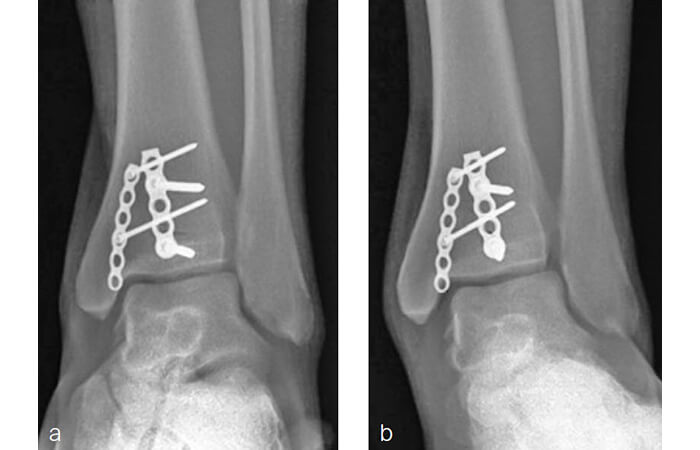 Рис.3. Виявлена на рентгенограмах в AP проекції нестабільність синдесмозу після фіксації перелому кісточки