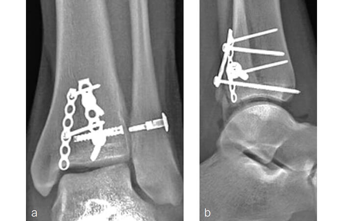 Рис.4. Рентгенограми в АР (а) та ML (b) проекціях після фіксації синдесмозу системою імплантатів FIBULINK
