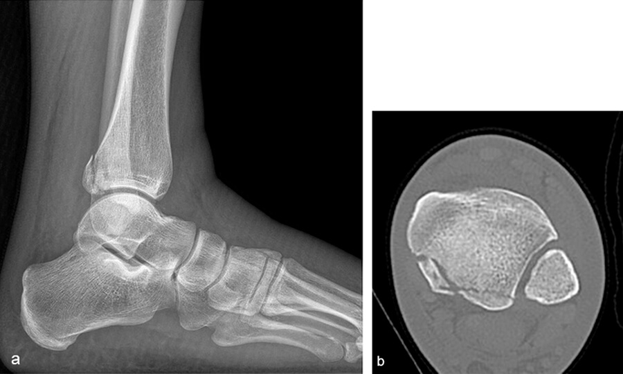 Рис.2. Рентгенограма в ML проекції (a) та осьова комп'ютерна томограма (b) перелому задньої частини кісточки